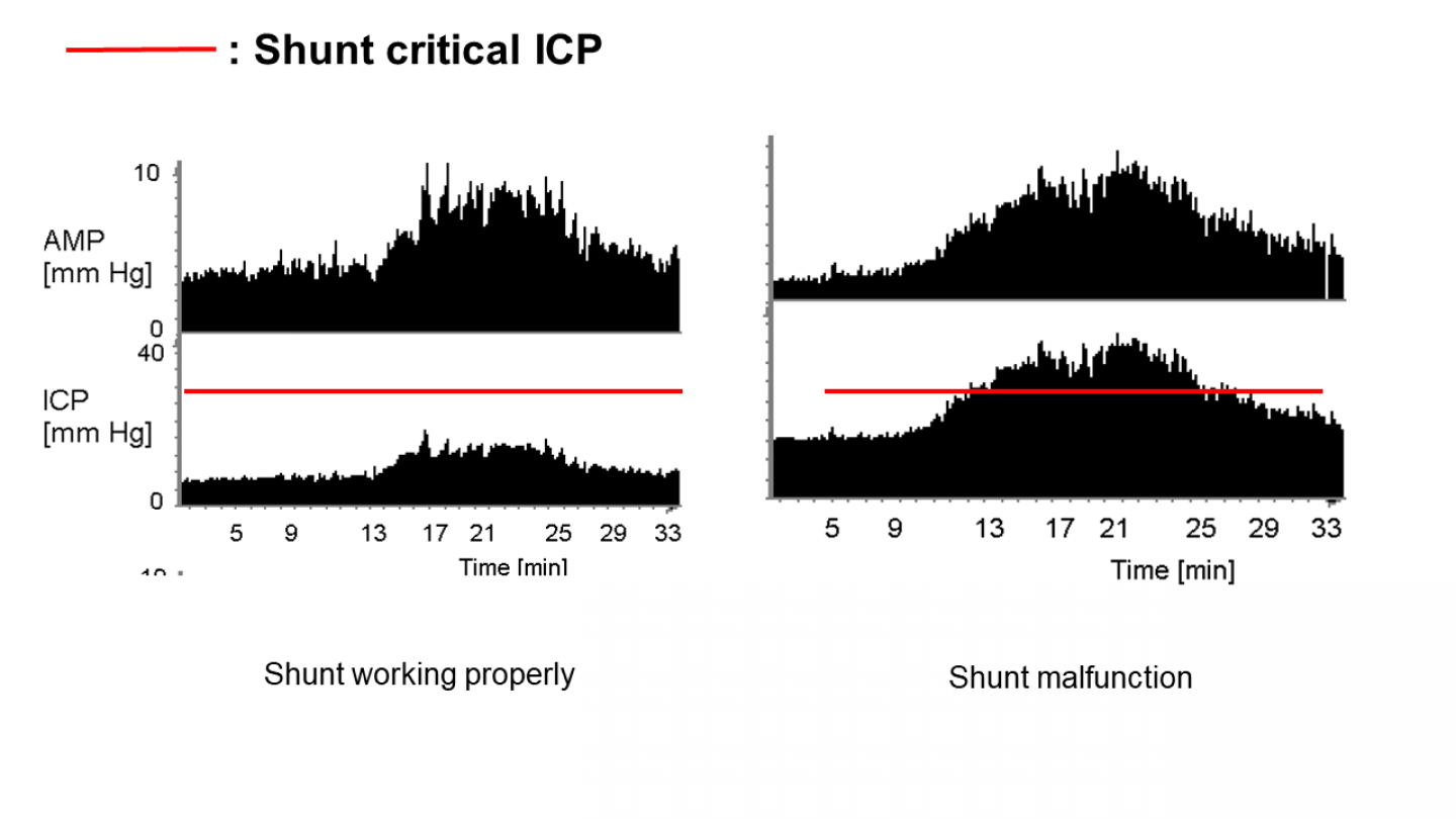 Csf Shunt Valve Occlusion—Does Csf Protein And Cell Count – PUARRO